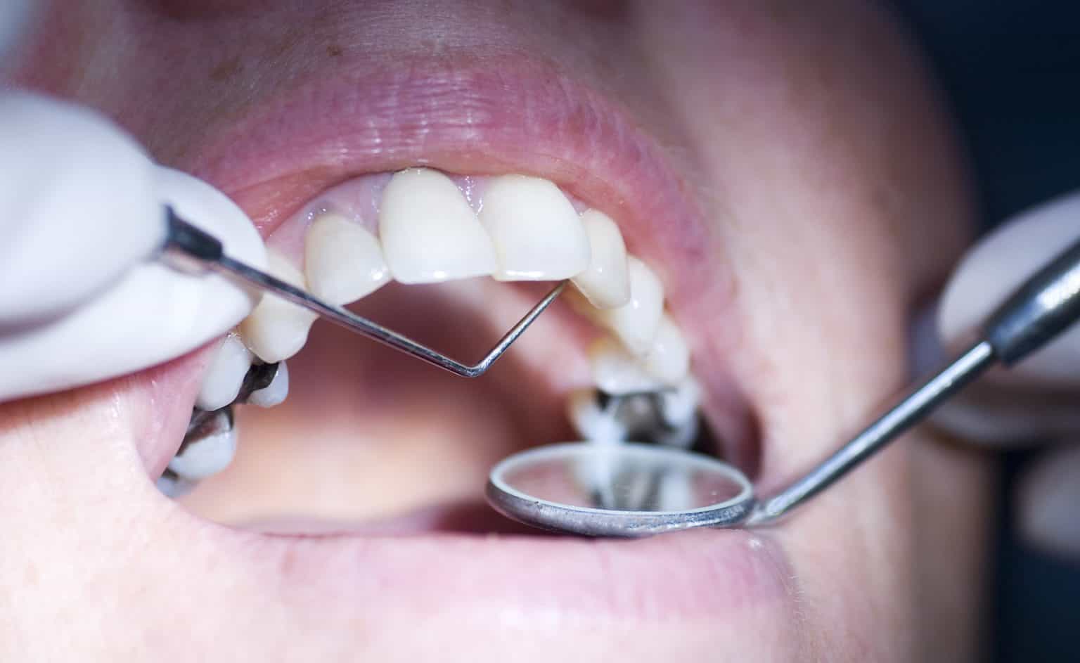 What To Do If a Temporary Dental Filling Falls Out
