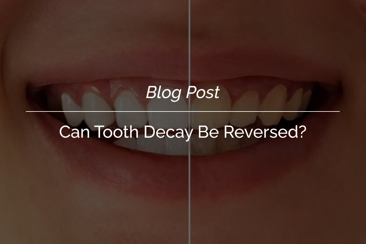 Can Tooth Decay Be Reversed_