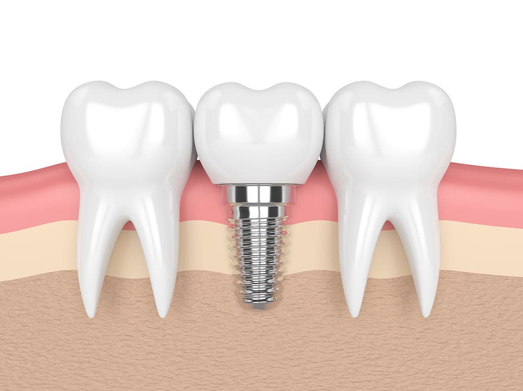 Dental Implants Templestowe & Manningham