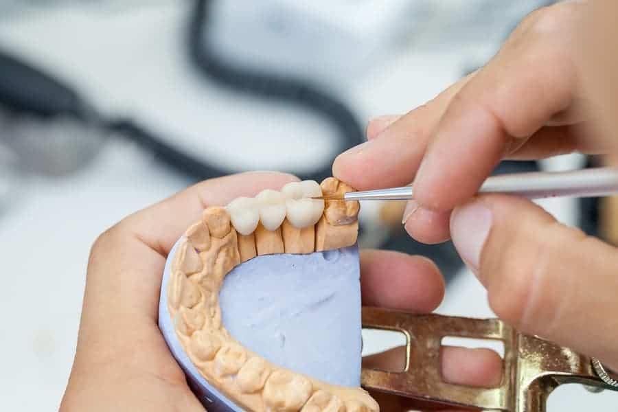 dental crowns and bridges in Templestowe and Manningham