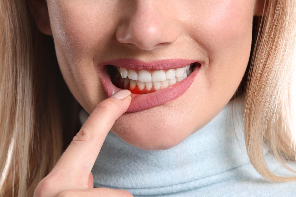 woman pulling down lower lip to reveal reddened gums