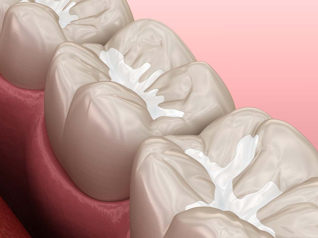 dental sealants image