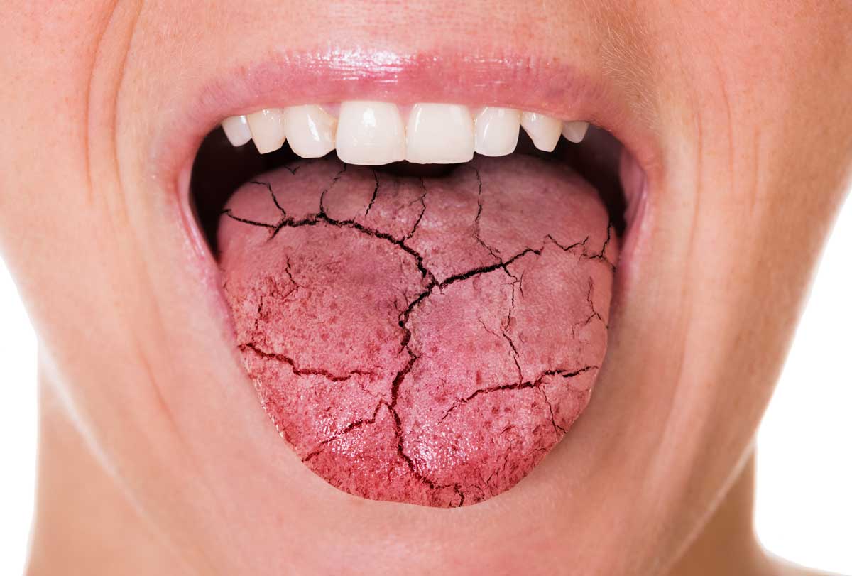 Woman Mouth and Broken Tongue with Cracks